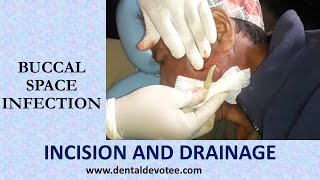 Incision and Drainage of Buccal space infection by Dr Raman Dhungel [upl. by Yltnerb]