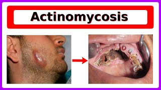 actinomycosis [upl. by Alenson659]