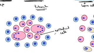 GENERAL PATHOLOGY 36  Tissue reactions in different types of granulomas DR SAMEH GHAZY [upl. by Wooldridge]