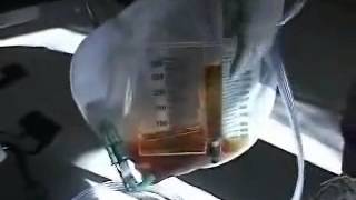 Foley Catheter Tubing and Collection Bag Free Nursing Video Lecture [upl. by Rebeka]