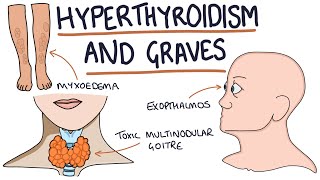 Understanding Hyperthyroidism and Graves Disease [upl. by Nivrac]