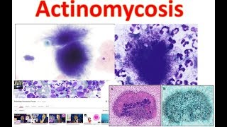 Actinomycosis Medschooltutorial [upl. by Nnylassej]