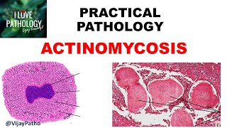 Practical Pathology ACTINOMYCOSIS [upl. by Ikoek]