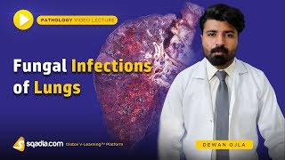 Fungal Infections of Lungs  Actinomycosis Histoplasmosis Coccidioidomycosis  Introduction [upl. by Thorr405]